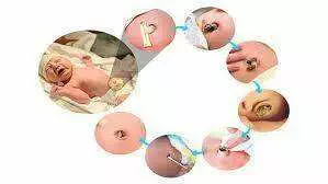 different stages of umbilical cord stump from clamping to falling off